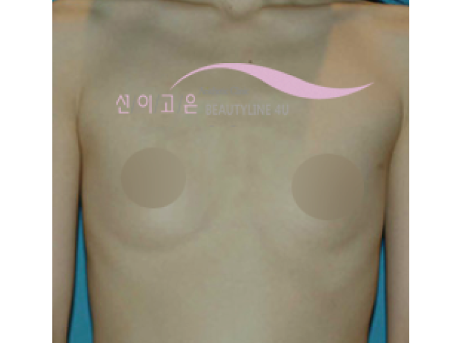 after-edit-breast-2