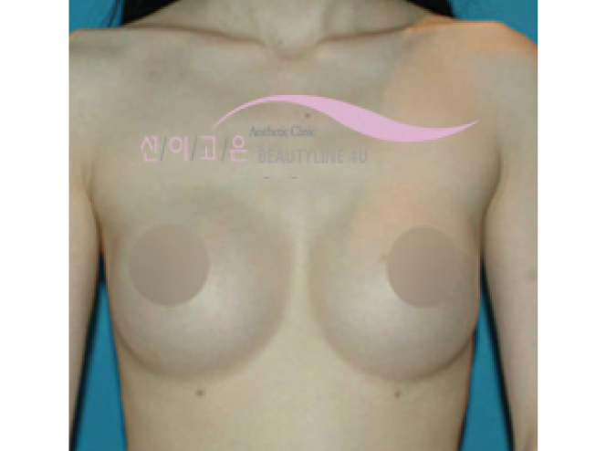 after-edit-breast-2a