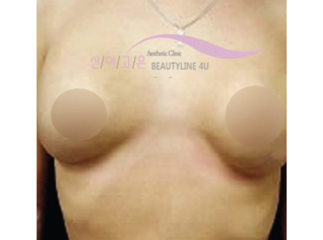 after-edit-breast-3