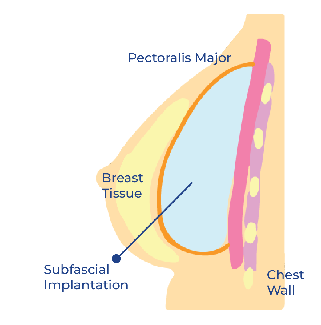 breast 4-34